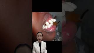 Giảm hô bằng nhổ răng liệu có hiệu quả ? Dr Ngọc Yến #nhakhoa #niềng_răng #dentist