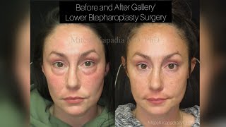 Before and After Gallery - Cosmetic Lower Eyelid Surgery