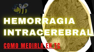 ⚠️▶️✔️COMO MEDIR UNA HEMORRAGIA INTRACEREBRAL EN TOMOGRAFÍA❓