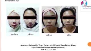 0811 1721 280, Cara bibir merah di Kalibata City Rinanda  Skin Care Center