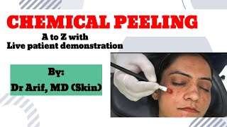 Chemical peeling- Detailed live patient demonstration video @DrArifMDDermatologist #chemicalpeel #melasma