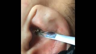 Blackheads in Ear