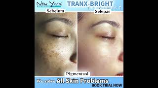 Get Spotless Skin With TRANX-BRIGHT Treatment!