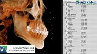 Class III Malocclusion