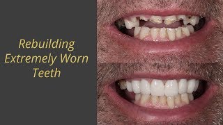 Extreme Tooth Wear - How we rebuilt it