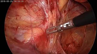 Endoscopic Totally extraperitoneal inguinal hernia repair with mesh (1.5X)