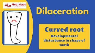 Dilaceration l Developmental tooth alteration l Oral pathology l Mediklaas