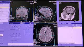 mri brain epilepsy