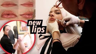 J'ai fait des LIP INJECTIONS! *reaction de mes proches + évanouissement en live*