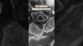 VIRUS EIPSTEIN BARR MONONUCLEOSIS INFECCIOSA