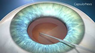 What are Cataracts?