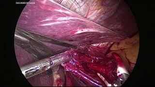 Laparoscopic Hellers Cardiomyotomy for Achalasia Cardia