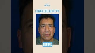 Lower Eyelid Bleph✨