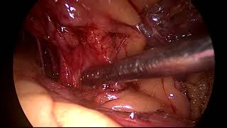 gall bladder removal surgery  in cirrhosis of liver