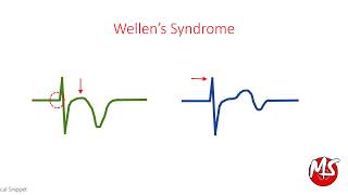 Wellen's Syndrome - ECG (High Risk for Myocardial Infarction)