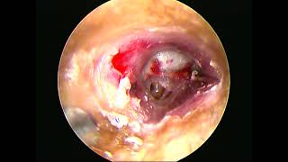 Endoscopic two handed tragal island cartilage tympanoplasty-dr.shreekantha acharya