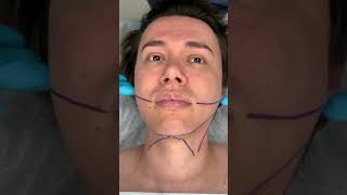 Minimally Invasive Jawline Sculpting with ThermiTight & Dermal Fillers