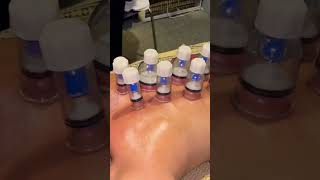 Cupping Therapy #thesbfitness #cupping #therapy #viral #youtubeshorts