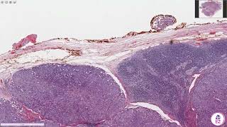 Acinic cell carcinoma