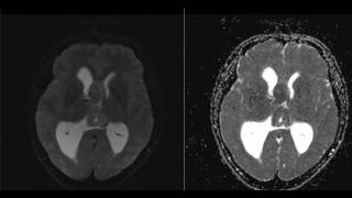 Central neurocytoma