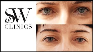 Dr SW Clinics - Non Surgical Blepharoplasty Testimonial