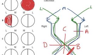 How to Biology & Anatomy: Optic pathways, visual fields and the lesions