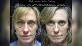 Before and After Gallery - Cosmetic Upper and Lower Eyelid Surgery