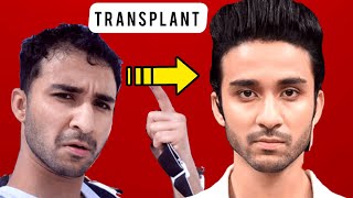 RAGHAV JUYAL|TRANSPLANT|RECEDING|Hair|Line|HairFall|MINOXIDIL|FINASTERIDE|results|hindi|Celebrity