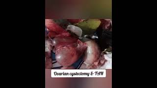 ovarian cystectomy & TAH #pcod#pcos#ovarian#cystitis#uterusproblem#fallopiantubes#health#gynaec