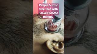 Do Face HIJAMA for acne dark spots & swelling #best #hijama #viral #detox #acne #fatloss  #safe #srk