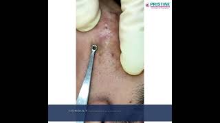 Comedone Extraction First Step of acne Treatment | Consultant Dermatologist Dr. Dhanyata