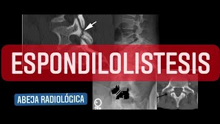 ⚠️⚠️ESPONDILOLISTESIS 🔺🔻