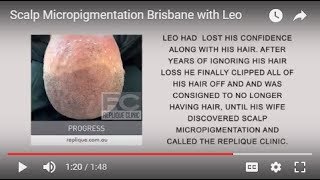 Scalp Micropigmentation Brisbane with Leo