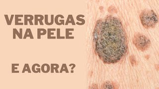 Verrugas - Quais os tipos e como tratar? Por Luiz Gameiro, dermatologista