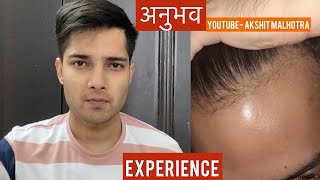 मेरे अनुभव| RESULTS| RECEDING Hairline Regrowth| Minoxidil Finasteride Hairtransplant| hindi|