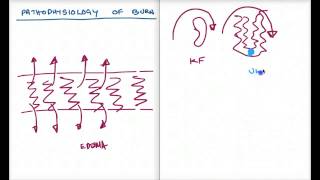 EASY WAYS TO UNDERSTAND PATHOPHYSIOLOGY OF BURN