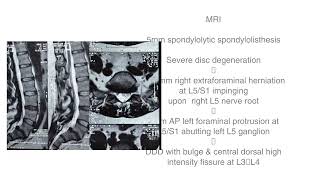 Cox® Technic Case - Dr. James Brandt - Female with Disc Herniation and Spondylolisthesis