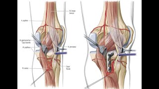 Posterolateral Tibial Plateau Fractures: Karl Frosch MD