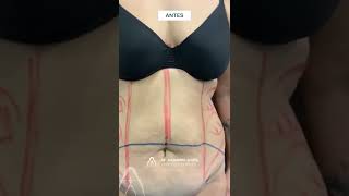 Dr. Alejandro Acuña | Vaser Lipo + Abdominoplastia