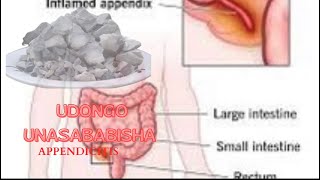 Je Kula Mawe ama udongo inasababisha appendicitis? What is appendicitis and it’s treatment.