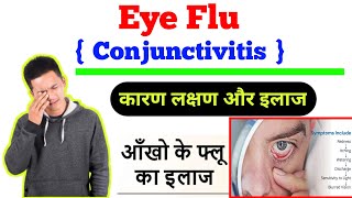 Eye Flu ( Conjunctivitis) का कारण लक्षण और इलाज। || Eye Flu ठीक करने का घरेलू उपाय।