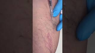 Eliminating Spider Veins