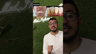 🦷 التهاب و نزيف اللثة 🩸مع غسيل الاسنان