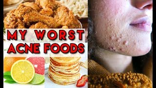 6 Worst Foods For Acne / Little Bumps | Acne causing foods