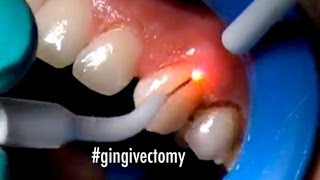 ตัดเหงือกด้วยเลเซอร์ (Laser Gingivectomy)