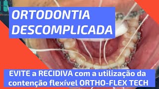 Dica de Ortodontia: Como instalar a contenção Ortho-Flex Tech para ter tratamentos mais previsíveis