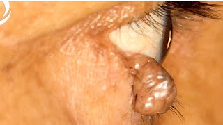 Large Eyelid Margin Growth Surgery