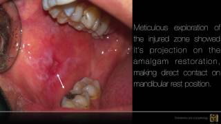 Amalgam-induced oral lichenoid lesion