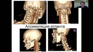 Нейрохирургия шейного отдела позвоночника и спинного мозга. #нейрохирург #нейрохирургия