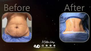 Tummy Tuck شد الجلد المترهل فى عياداتنا